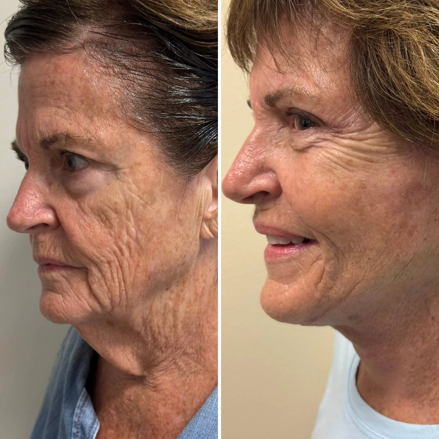 Before and after ModernLift deep plane facelift and neck lift, angled profile view of the midface, jawline and neck, Modern Dermatology South Tampa