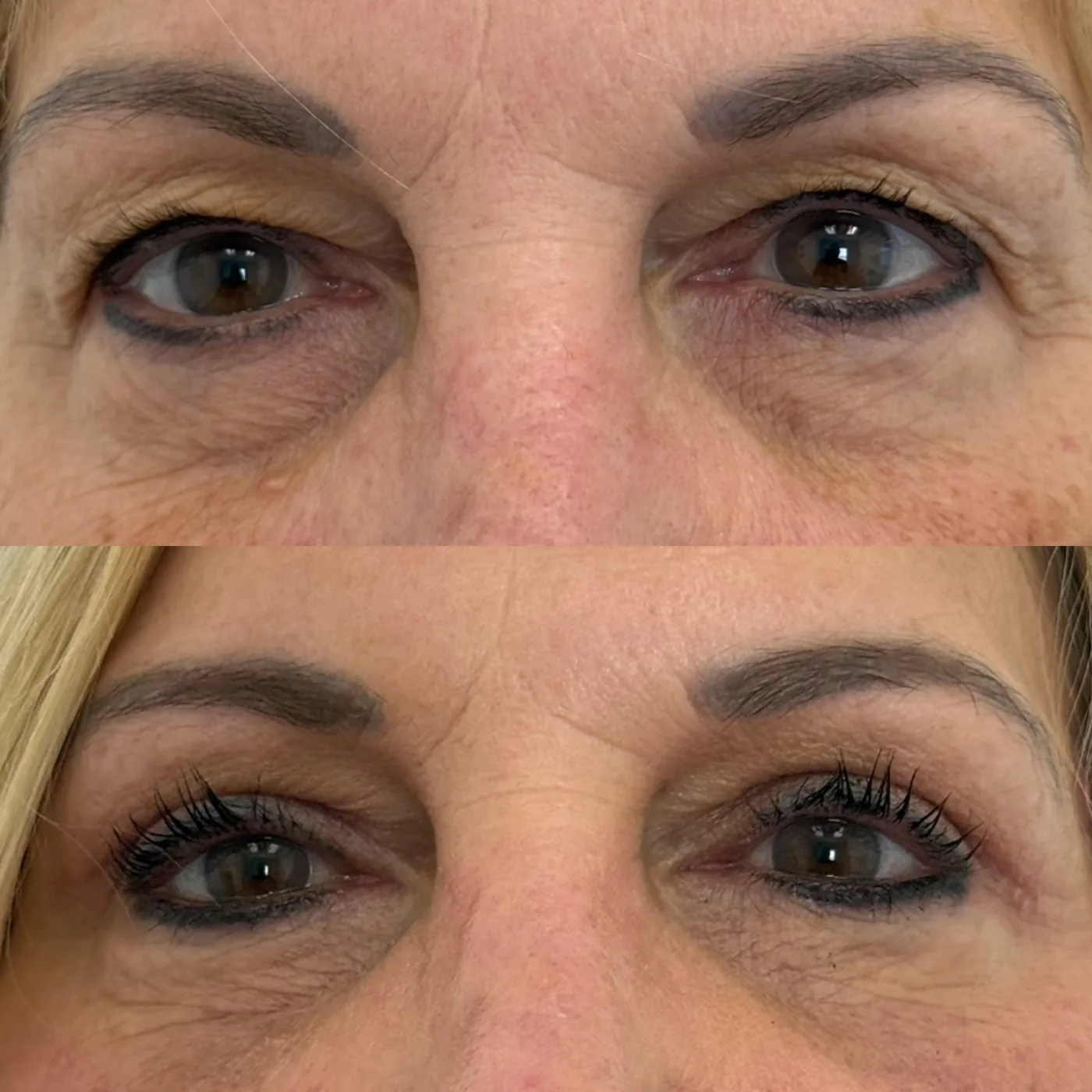 Before and after ModernLift mini facelift, front view of the upper and lower eyelids, Modern Dermatology South Tampa
