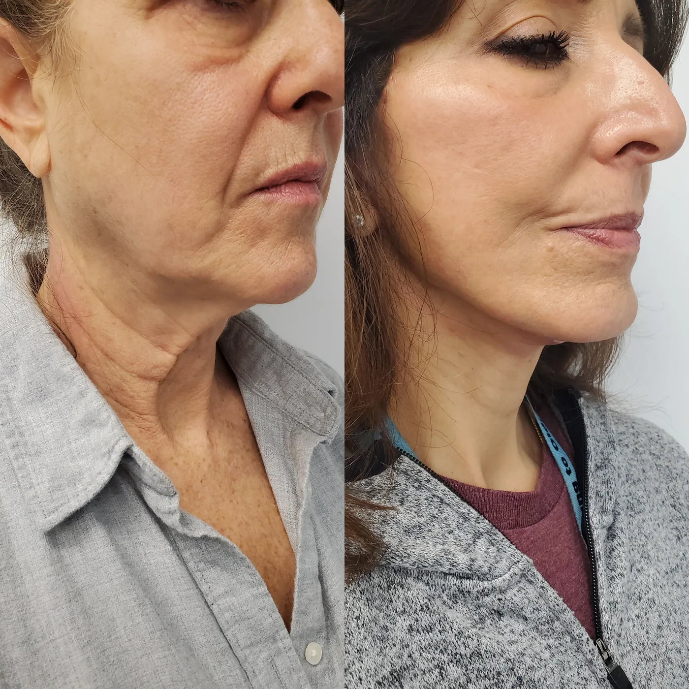 Before and after ModernLift deep plane facelift and neck lift, three-quarter view of the jawline and neck, Modern Dermatology South Tampa