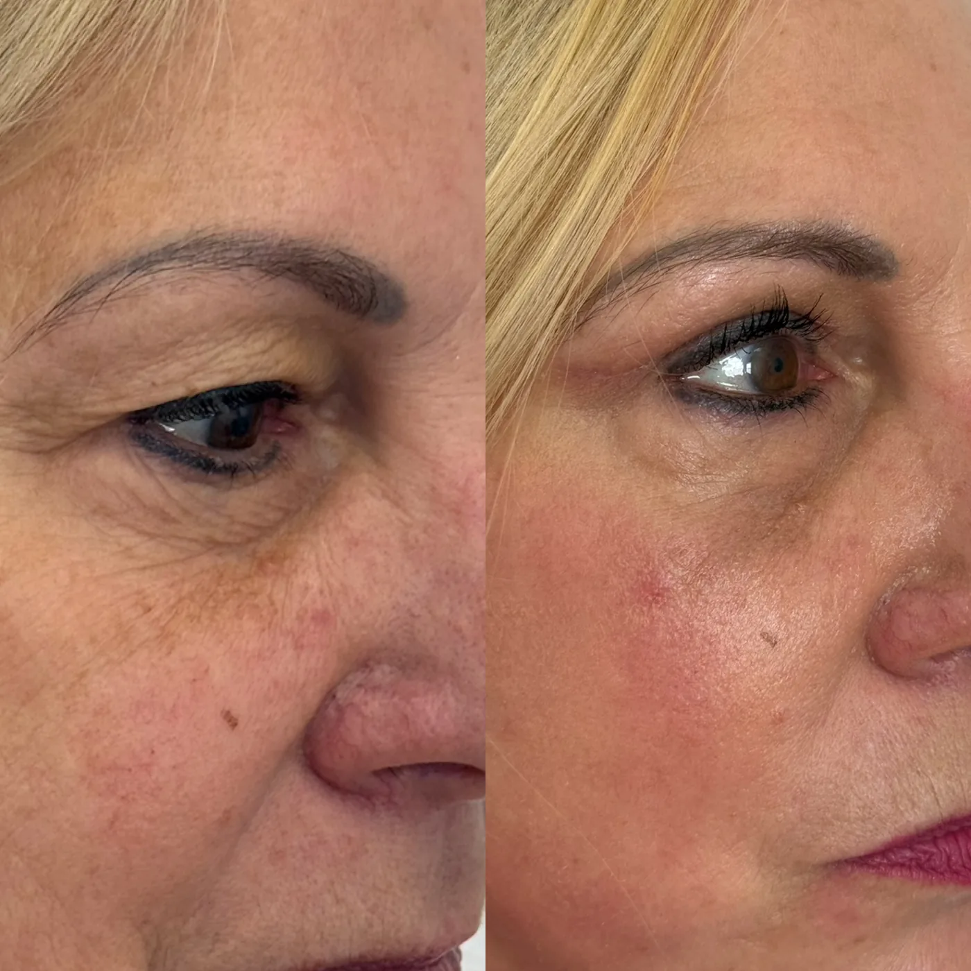 Before and after ModernLift mini facelift, close view of the under-eye and midface, Modern Dermatology South Tampa