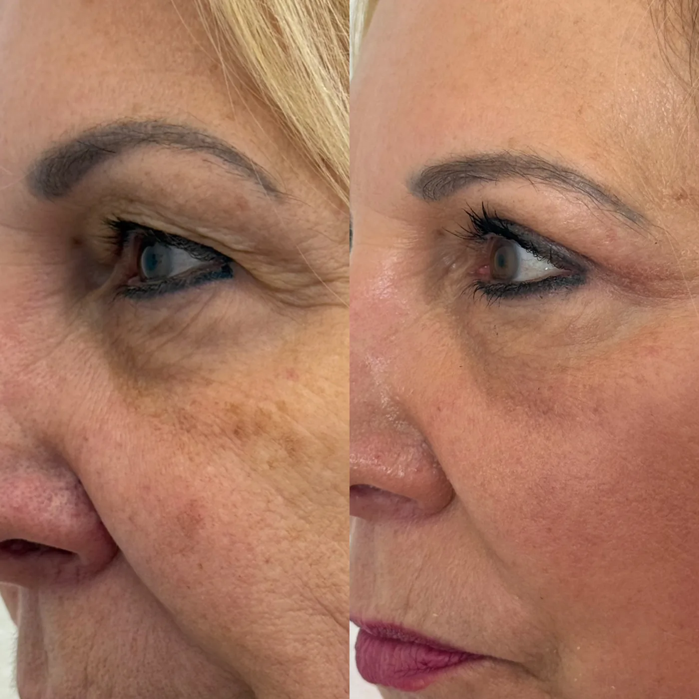 Before and after ModernLift mini facelift, close view of the outer eye and upper cheek, Modern Dermatology South Tampa