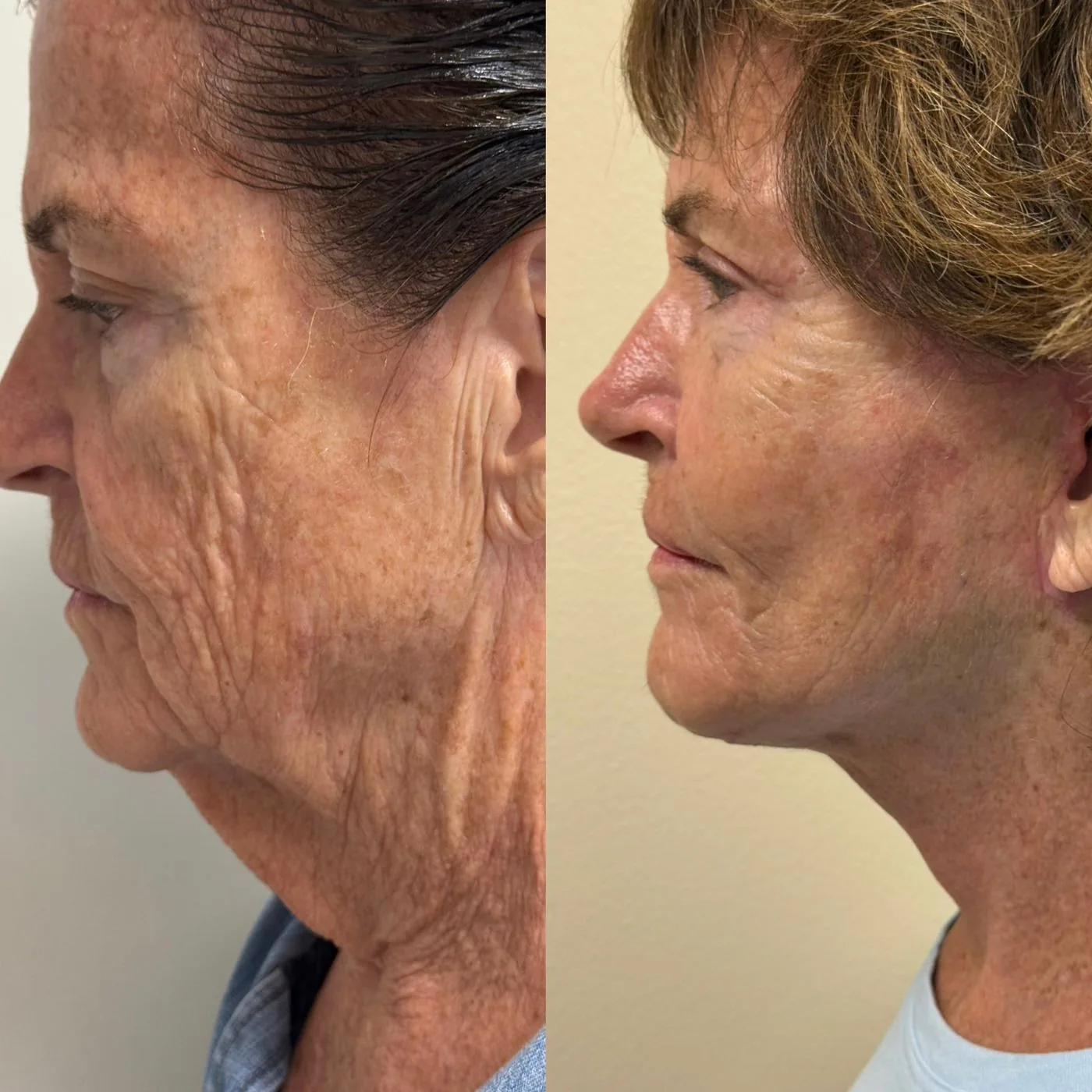 Before and after ModernLift deep plane facelift and neck lift, full profile view of the cheek, jawline and neck, Modern Dermatology South Tampa