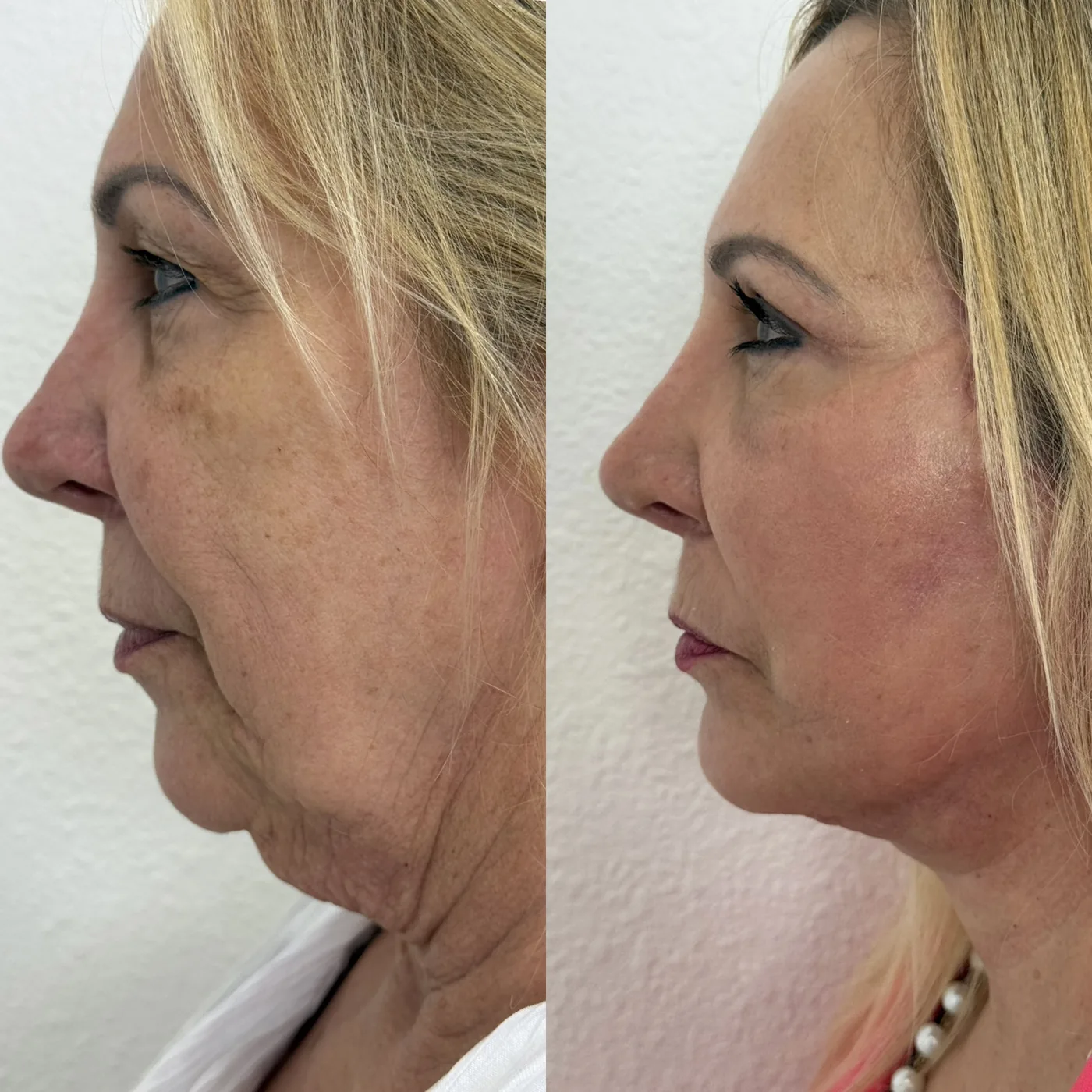 Before and after ModernLift deep plane facelift and neck lift, full profile view of the jawline and neck, Modern Dermatology South Tampa