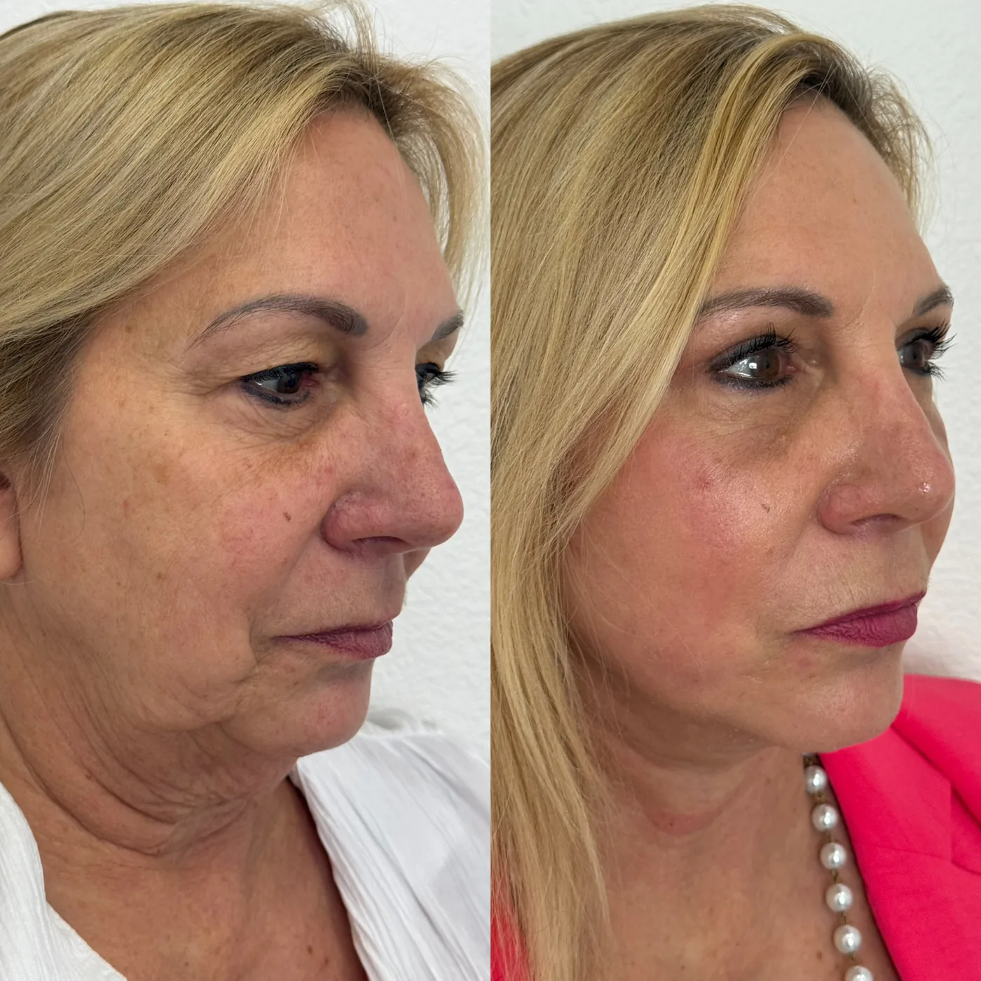 Before and after ModernLift deep plane facelift and neck lift, three-quarter view of the midface, jawline and neck, Modern Dermatology South Tampa